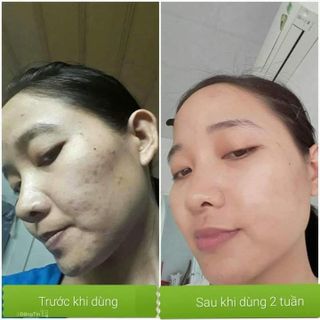 Thuốc đặc trị nám tàn nhang nốt ruồi đôngy