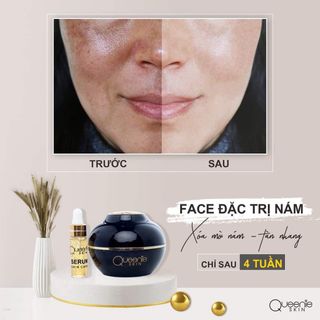 Kem đặt trị nám chính hãng queenie Skin