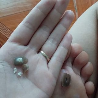 Thuốc trị mụn ruồi mun thin nam tan nhang