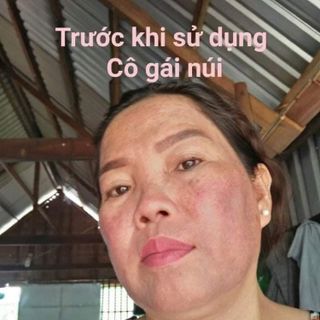 Nạ cô gái núi trị nám tàn nhang