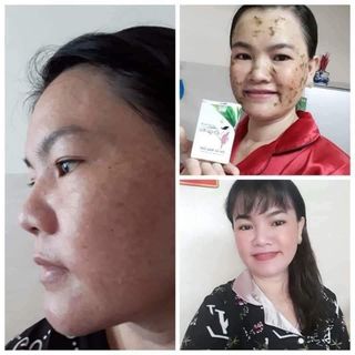 Nạ cô gái núi trị nám tàn nhang