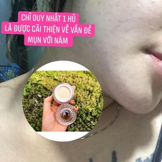 KEM FACE ĐÔNG Y trị mụn- nám