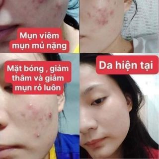 SERUM CHẤM MỤN 12H HUỲNH ĐỖ