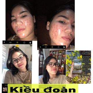 DEMEJINE KEM TRỊ MỤN