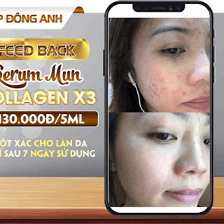 SERUM TRỊ MỤN COLLAGEN X3