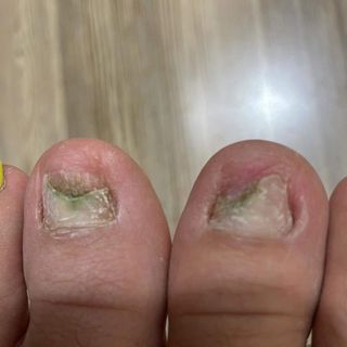 Serum nấm móng tay sh