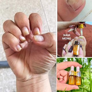 Serum nấm móng tay sh