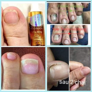 Đặc trị nấm móng gia truyên
