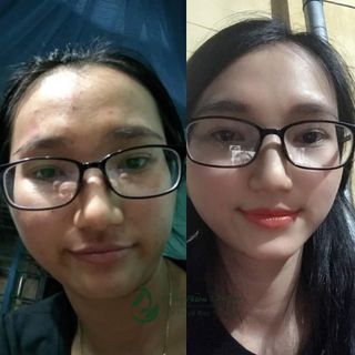 Serum Xương Rồng Xóa Mụn, Không Bong Tróc Mộc Thiên Hương