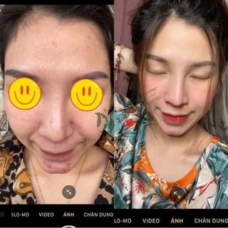 Serum Xương Rồng Xóa Mụn, Không Bong Tróc Mộc Thiên Hương