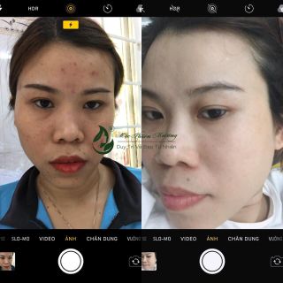 Serum Xương Rồng Xóa Mụn, Không Bong Tróc Mộc Thiên Hương