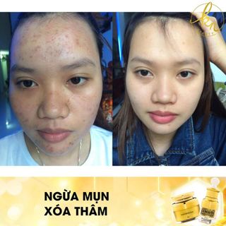 Serum dưỡng da ngừa thâm mụn chính hãng Knbeauty