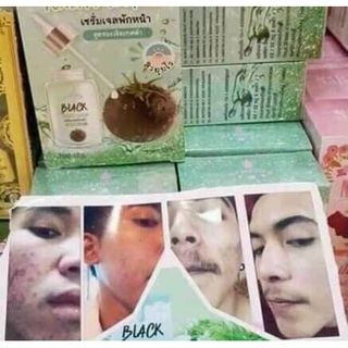 Serum cà chua đen ngăn ngừa mụn