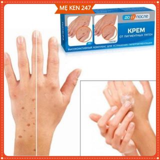 Kem đồi mồi kpem Nga 50ml xóa mờ đồi mồi tay, tàn nhang dưỡng da tay trắng sáng mịn màng giá sỉ