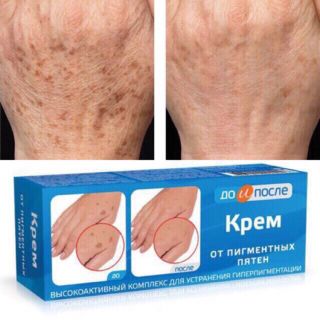 Kem đồi mồi kpem Nga 50ml xóa mờ đồi mồi tay, tàn nhang dưỡng da tay trắng sáng mịn màng