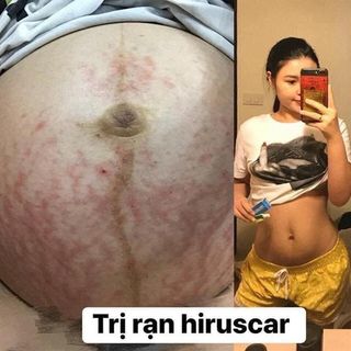 Trị sẹo Hiruscar Thái Lan 7g