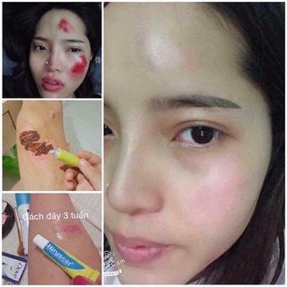 Trị sẹo Hiruscar Thái Lan 7g