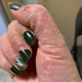 Kem bôi vẩy nến á sừng nội địa Trung