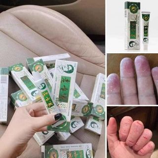 Kem bôi vẩy nến á sừng nội địa Trung
