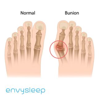 [Follow_ sale] Đệm silicon CHÍNH HÃNG ENVYSLEEP chống chai và cong vẹo/biến dạng ngón chân