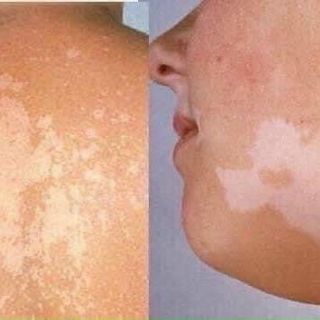 Kem trị lang ben Fango B TL 15g