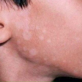 Kem trị lang ben Fango B TL 15g