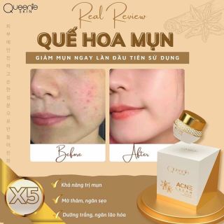 ĐẶC TRỊ MỤN “ QUẾ HOA MỤN”