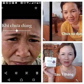 Kem trị nám và dưỡng trắng