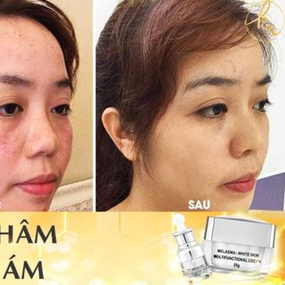 Kem Dưỡng Trắng Ngừa Nám KN Beauty Melasma-White Skin Multifunctional Cream 25gram