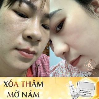 Kem Dưỡng Trắng Ngừa Nám KN Beauty Melasma-White Skin Multifunctional Cream 25gram