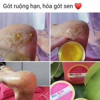 KEM MULL -ROSE TRỊ CÁC VẤN ĐỀ VỀ DA