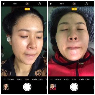 Dr mai trị mụn
