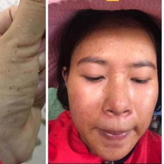 Dr mai trị mụn