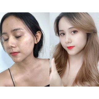 hu serum giúp sạch mụn,các loại mụn thâm cho bạn làn da đẹp lại mẫu mới tuyệt phẩm