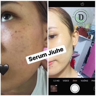 erum trị thâm JIUHE hàng chính hãng 100% SẢN PHẨM TÁI TẠO LÀN DA TRẮNG HỒNG TƯƠI TRẺ. Tái tạo làn da phục hồi và bổ sung các dưỡng chất cho da