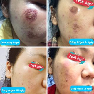 Dầu Argan nguyên chất 10ml - trị mụn, thâm, viêm da cơ địa