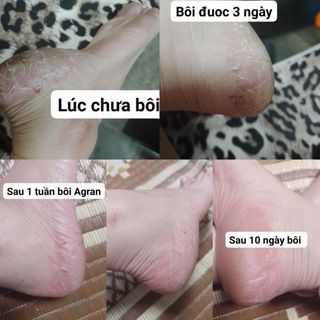 Dầu Argan nguyên chất 10ml - trị mụn, thâm, viêm da cơ địa