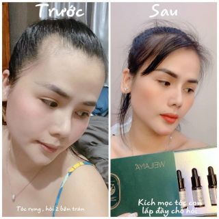 Huyết thanh kích mọc tóc siêu nhanh Weilaiya