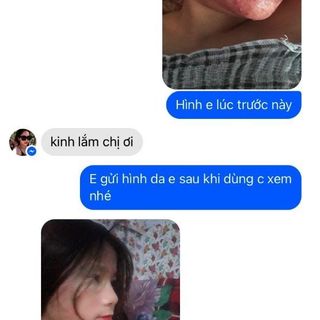 trị mụn thảo dược