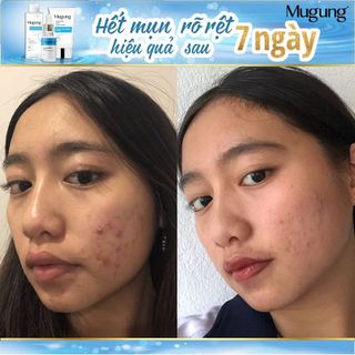 Serum Mugung trị mụn hiệu quả mụn đầu đen mụn bọc (Làm xẹp không bong da) Acne Treatment 15ml)