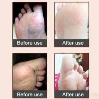 Kem dưỡng cao ngựa trị nứt nẻ khô da chân , tay nội địa trung