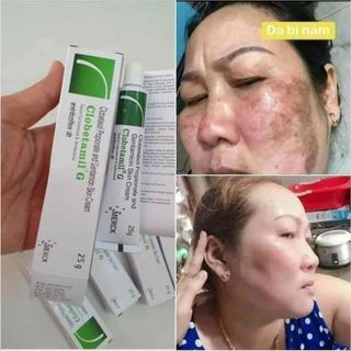 Tuýp kem chấm trị nám Clobetamil G Thái Lan giá sỉ