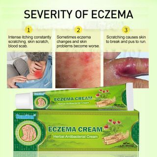 Kem ECZEMA CREAM Đặc Trị bệnh vẩy nến ,Tay chân lột da, da mẩn ngứa , mụt nước trên da ( 20g )