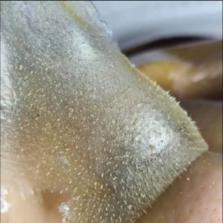 Lột Mụn Cám- Mụn Đầu Đen Xạ Can Min