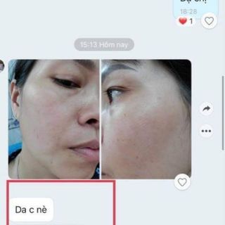 Tinh chất Hồng Hoa đặc trị Nám và Tàn nhang