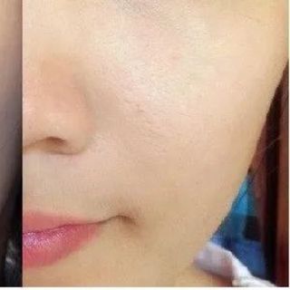 Bộ Đặc Trị Sẹo Actiscar giá sỉ