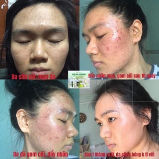 Serum Trị Mụn Diếp Ca