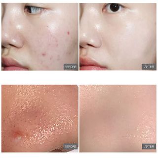 Mặt Nạ gạt 2trong1 chuyên loại bỏ Mụn trứng cá, mụn cám , xe khích lỗ chân lông , làm sạch da (2ml*55mieng)
