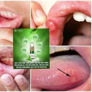 Serum trị hôi miệng huyền phi