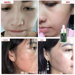 Peel da, Thay Da Sinh Học Linh Hương, Light Peel X10 làm trắng da, tái tạo làn da mới, thay da tại nhà